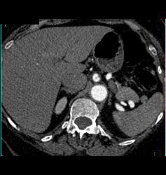 Celiac Artery Dissection - CTisus CT Scan