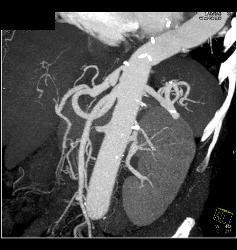 Celiac Artery Dissection - CTisus CT Scan