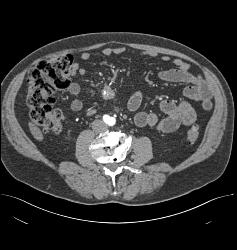 Carcinoid Tumor - CTisus CT Scan