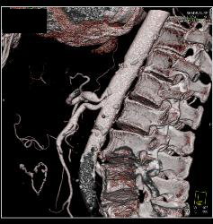 Median Arcuate Ligament Syndrome - CTisus CT Scan