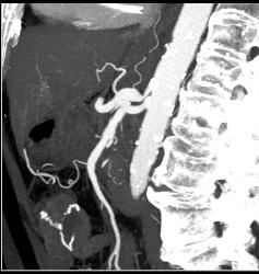 Median Arcuate Ligament Syndrome - CTisus CT Scan