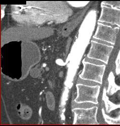 Median Arcuate Ligament Syndrome - CTisus CT Scan