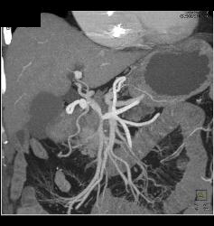 Pancreatic Cancer Encases PV/SMV/SV Confluence - CTisus CT Scan