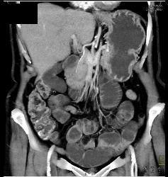 Dilated Small Bowel Loops Due to Adhesions - CTisus CT Scan