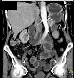 Dilated Small Bowel Loops Due to Adhesions - CTisus CT Scan