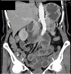 Superior Mesenteric Artery (SMA) Syndrome - CTisus CT Scan