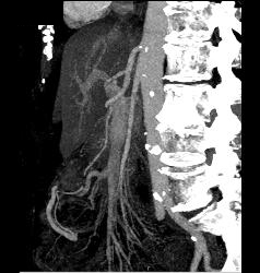 Superior Mesenteric Artery (SMA) Syndrome - CTisus CT Scan