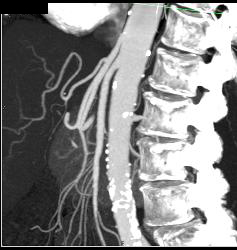 Superior Mesenteric Artery (SMA) Syndrome - CTisus CT Scan