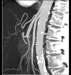 Superior Mesenteric Artery (SMA) Syndrome - CTisus CT Scan