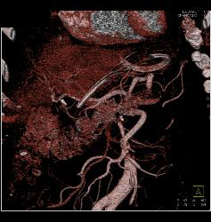 Repair of Superior Mesenteric Artery (SMA) Pseudoaneurysm - CTisus CT Scan