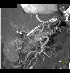 Repair of Superior Mesenteric Artery (SMA) Pseudoaneurysm - CTisus CT Scan