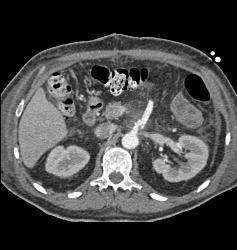 Repair of Superior Mesenteric Artery (SMA) Pseudoaneurysm - CTisus CT Scan