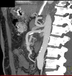 Repair of Superior Mesenteric Artery (SMA) Pseudoaneurysm - CTisus CT Scan