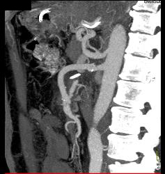 Superior Mesenteric Artery (SMA) Pseudoaneurysm - CTisus CT Scan