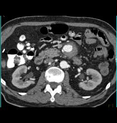 Superior Mesenteric Artery (SMA) Pseudoaneurysm - CTisus CT Scan