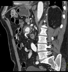 Superior Mesenteric Artery (SMA) Pseudoaneurysm - CTisus CT Scan