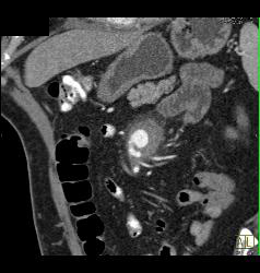 Superior Mesenteric Artery (SMA) Pseudoaneurysm - CTisus CT Scan