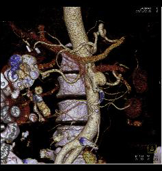 Superior Mesenteric Artery (SMA) Pseudoaneurysm - CTisus CT Scan