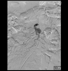 Superior Mesenteric Artery (SMA) Pseudoaneurysm - CTisus CT Scan