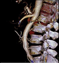 3d Visualization of IMA - CTisus CT Scan