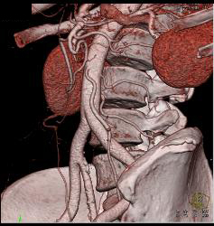 3D Visualization of IMA - CTisus CT Scan