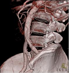 3D Visualization of IMA - CTisus CT Scan