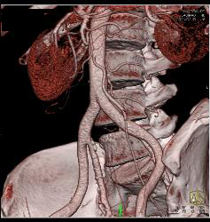 3D Visualization of IMA - CTisus CT Scan