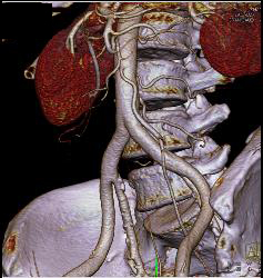 3D Visualization of IMA - CTisus CT Scan