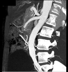 Median Arcuate Ligament Syndrome - CTisus CT Scan