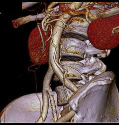 Median Arcuate Ligament Syndrome - CTisus CT Scan