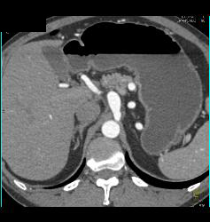 Celiac Artery Aneurysm and Web in SMA - CTisus CT Scan