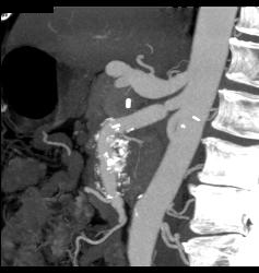 Celiac Artery Aneurysm and Web in SMA - CTisus CT Scan