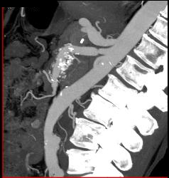 Superior Mesenteric Artery (SMA) Stenosis With Repaired SMA - CTisus CT Scan