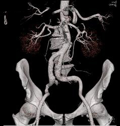 Superior Mesenteric Artery (SMA) Stenosis With Repaired SMA - CTisus CT Scan