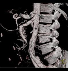 Superior Mesenteric Artery (SMA) Stenosis With Repaired SMA - CTisus CT Scan