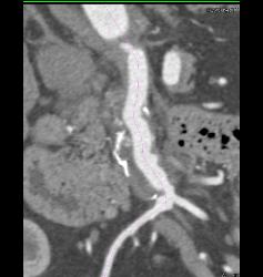 Superior Mesenteric Artery (SMA) Stenosis With Repaired SMA - CTisus CT Scan