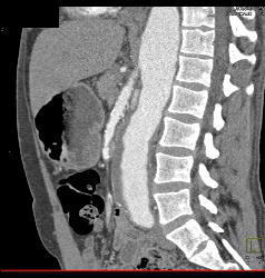 Superior Mesenteric Artery (SMA) Stenosis With Repaired SMA - CTisus CT Scan