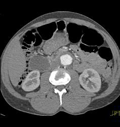 Superior Mesenteric Artery (SMA) Stenosis With Repaired SMA - CTisus CT Scan