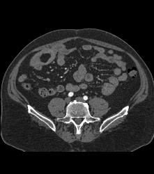 Meckel's Diverticulum With An Intussusception- Incredible Diagnosis - CTisus CT Scan