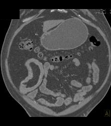 Meckel's Diverticulum With An Intussusception- Incredible Diagnosis - CTisus CT Scan