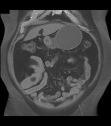 Meckel's Diverticulum With An Intussusception- Incredible Diagnosis - CTisus CT Scan