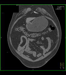 Meckel's Diverticulum With An Intussusception- Incredible Diagnosis - CTisus CT Scan