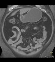 Meckel's Diverticulum With An Intussusception- Incredible Diagnosis - CTisus CT Scan