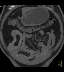 Meckel's Diverticulum With An Intussusception- Incredible Diagnosis - CTisus CT Scan