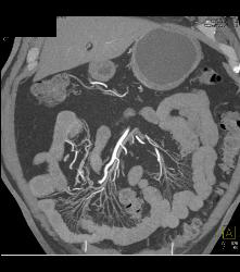 Meckel's Diverticulum With An Intussusception- Incredible Diagnosis - CTisus CT Scan