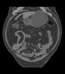 Meckel's Diverticulum With An Intussusception- Incredible Diagnosis - CTisus CT Scan