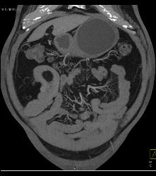 Meckel's Diverticulum With An Intussusception- Incredible Diagnosis - CTisus CT Scan