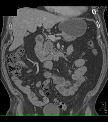 Meckel's Diverticulum With An Intussusception- Incredible Diagnosis - CTisus CT Scan