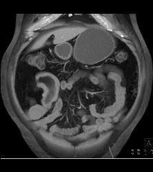 Meckel's Diverticulum With An Intussusception- Incredible Diagnosis - CTisus CT Scan