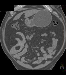 Meckel's Diverticulum With An Intussusception- Incredible Diagnosis - CTisus CT Scan